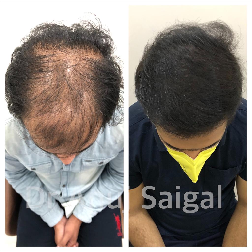 Best hair transplant doctor in delhi